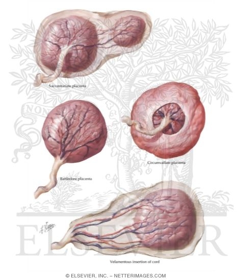 Placental Variations