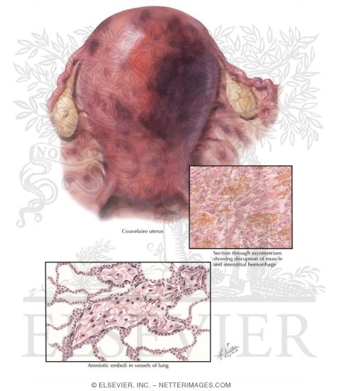 Watermarked preview of labeled image: Couvelaire Uterus, Maternal Pulmonary Embolism