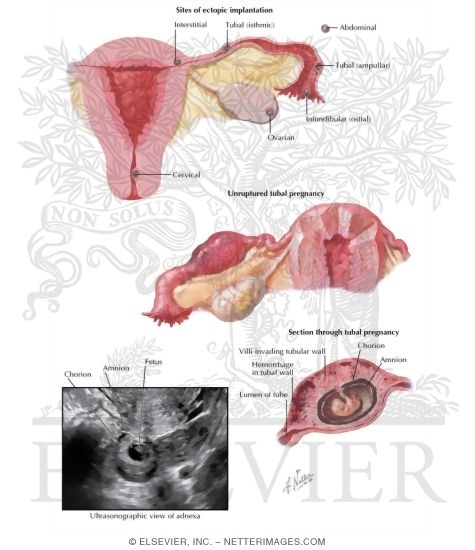 Watermarked preview of labeled image: Ectopic Pregnancy