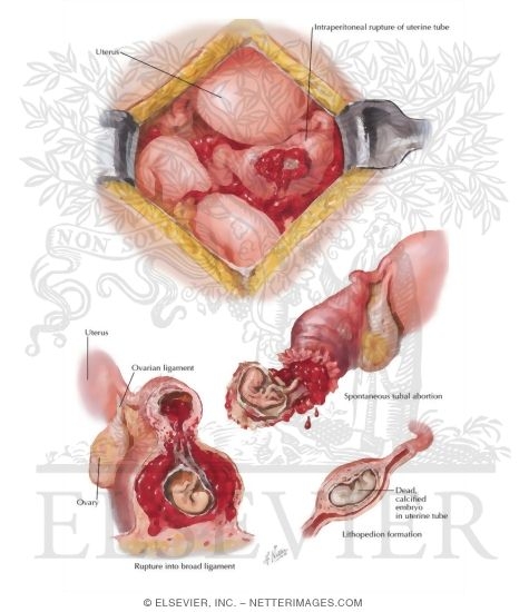Watermarked preview of labeled image: Ectopic Pregnancy II - Rupture, Abortion