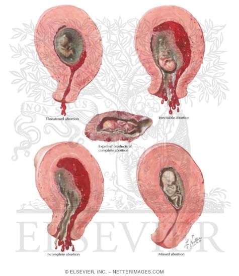 Watermarked preview of labeled image: Abortion