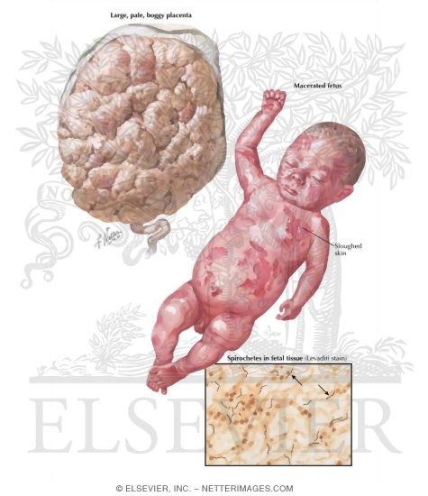 Watermarked preview of labeled image: Syphilis