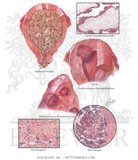 Watermarked preview of labeled image: Gestational Trophoblastic Disease