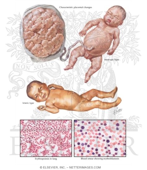 Watermarked preview of labeled image: Erythroblastosis Fetalis