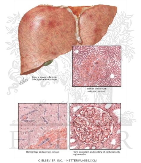 Watermarked preview of labeled image: Acute Toxemia of Pregnancy III - Visceral Lesions in Preeclampsia and Eclampsia