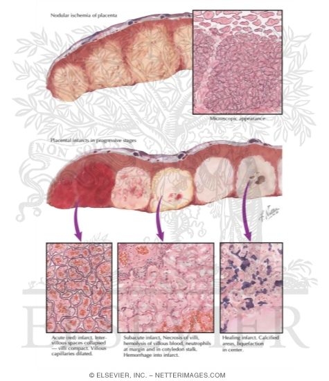 Watermarked preview of labeled image: Acute Toxemia of Pregnancy IV - Placental Lesions in Preeclampsia and Eclampsia, Infarcts