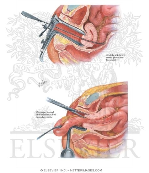Perforation of the Cervix