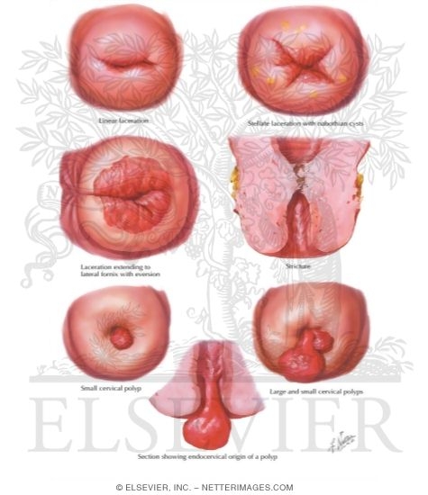 Cervical Polyps, Lacerations, and Stenosis