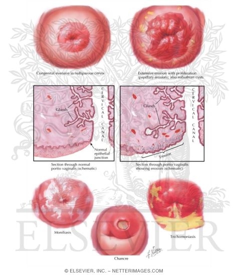 Cervicitis I - Erosions, Moniliasis, Trichomoniasis, Syphilis
