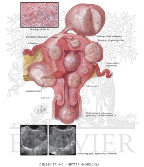 Watermarked preview of labeled image: Myoma (Fibroid) I - Locations