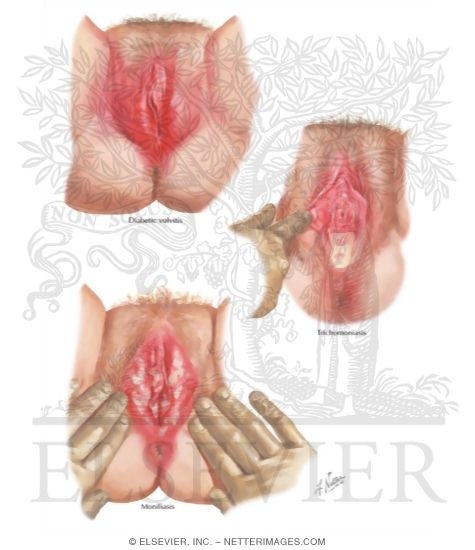 Watermarked preview of labeled image: Vulvitis I - Diabetes, Trichomoniasis, Moniliasis