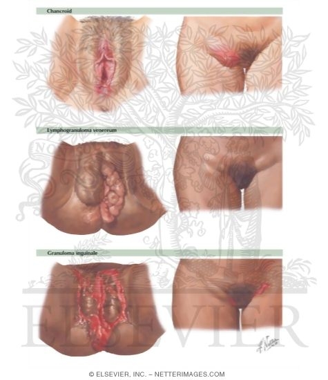 Watermarked preview of labeled image: Chancroid, Lymphogranuloma Venereum, Granuloma Inguinale