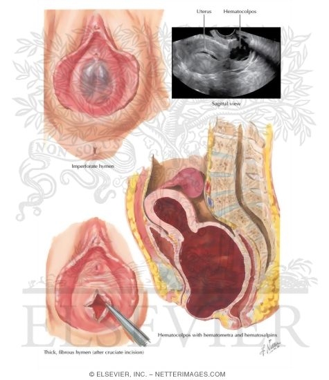 Imperforate Hymen, Hematocolpos, Fibrous Hymen
Hymenal Stenosis
Hematometra