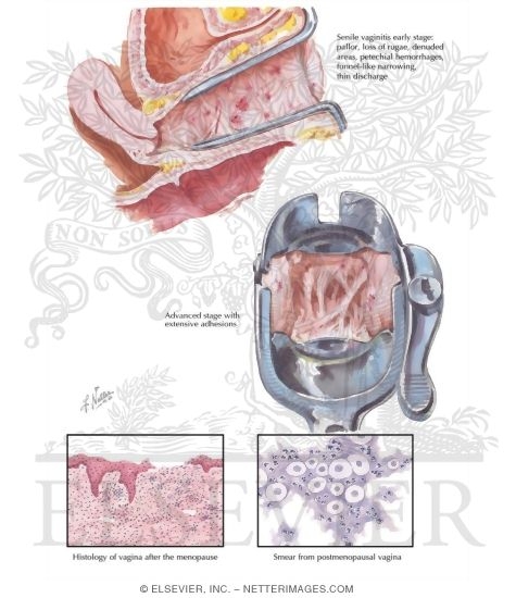 Atrophic Conditions
Vaginal Dryness