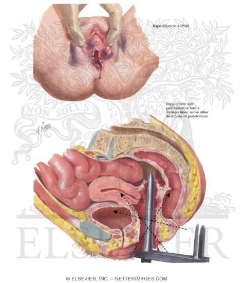 Watermarked preview of labeled image: Trauma