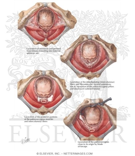 Obstetric Lacerations I - Vaginal Support and Muscles