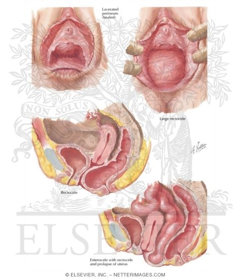 Rectocele, Enterocele