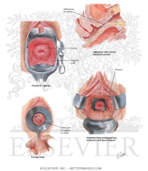 Watermarked preview of labeled image: Vaginitis III, Chemical, Traumatic