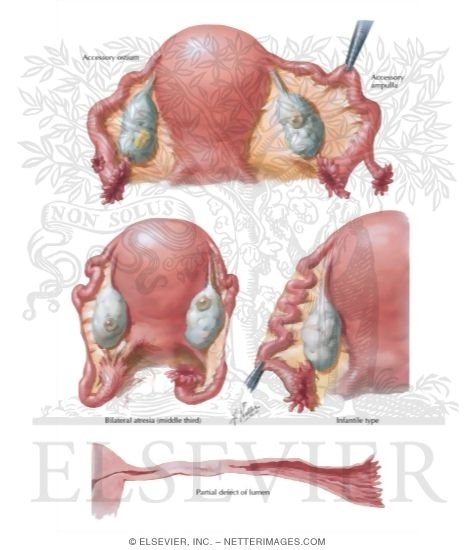 Watermarked preview of labeled image: Congenital Anomalies II - Atresia, Defects