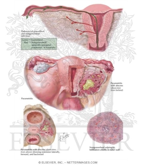 Pathways of Infection, Parametritis, Acute Salpingitis I
Endometritis