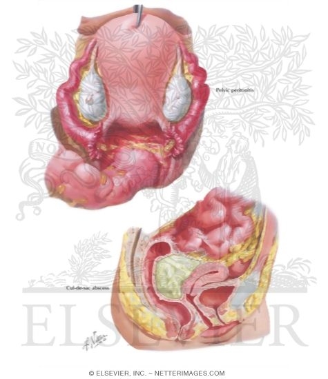 Watermarked preview of labeled image: Pelvic Peritonitis, Abscess