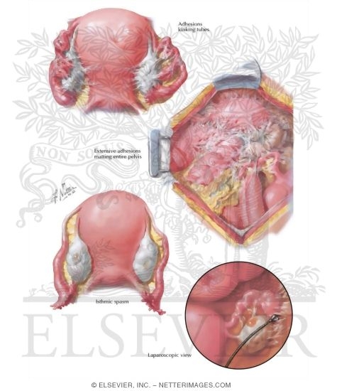 Watermarked preview of labeled image: Chronic Salpingitis, Adhesions, Differential Diagnosis