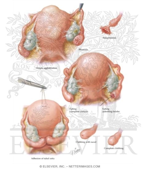 Obstruction Following Chronic Salpingitis