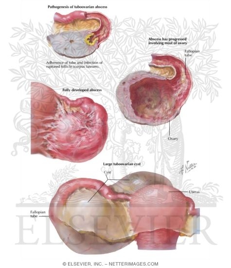 Tubo-ovarian Abscess