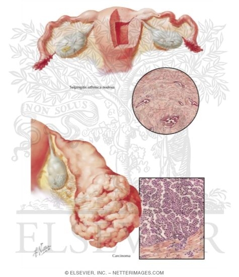 Watermarked preview of labeled image: Salpingitis Isthmica Nodosa, Carcinoma