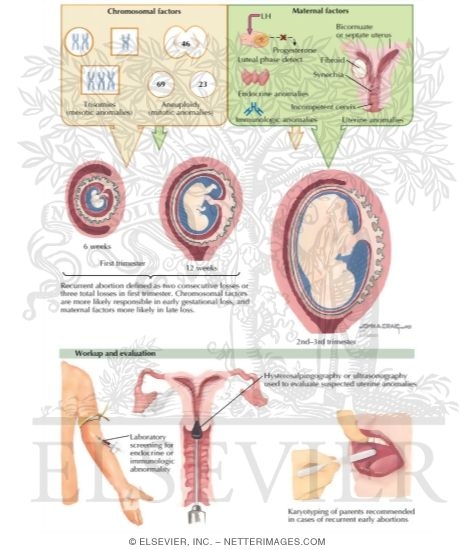 Recurrent Abortion
Abortion: Recurrent