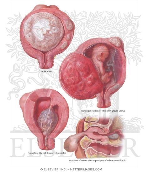 Myoma (Fibroid) II - Secondary Changes