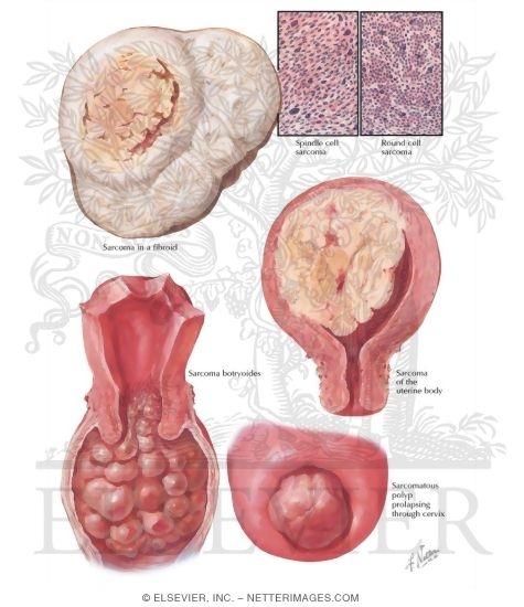 Sarcoma Botryoides