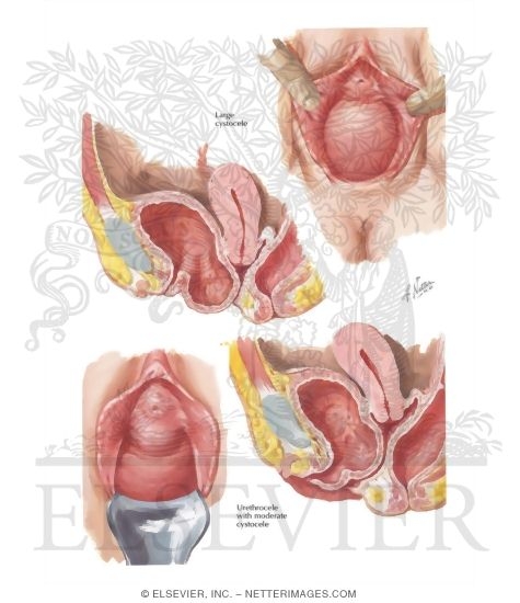 Cystocele, Urethrocele