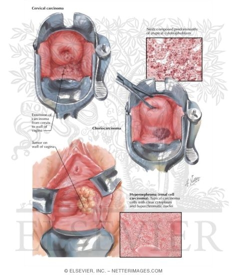 Watermarked preview of labeled image: Malignant Tumors II - Metastases and Extension