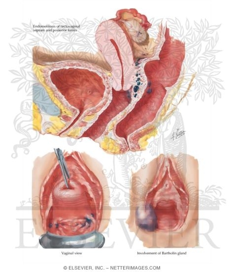 Endometriosis I - Vulva, Vagina, Cervix