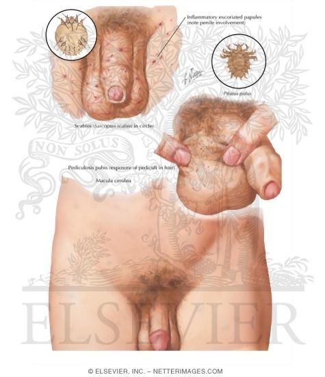 Dermatoses II - Arthropodic Origin