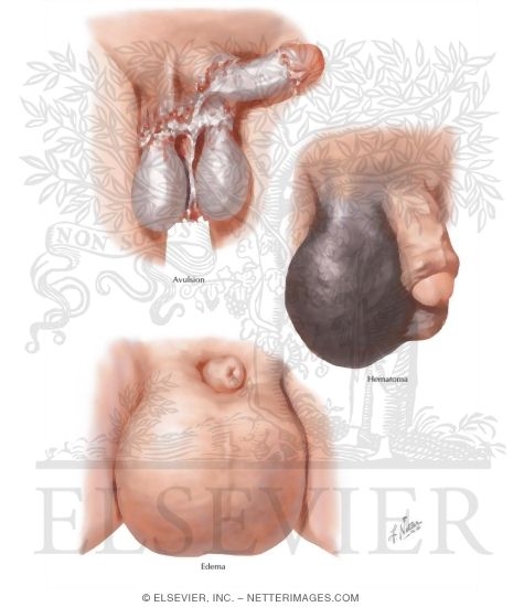 Watermarked preview of labeled image: Avulsion Edema, Hematoma