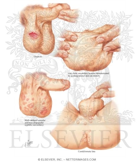Syphilis of the Scrotum and Perianal Area