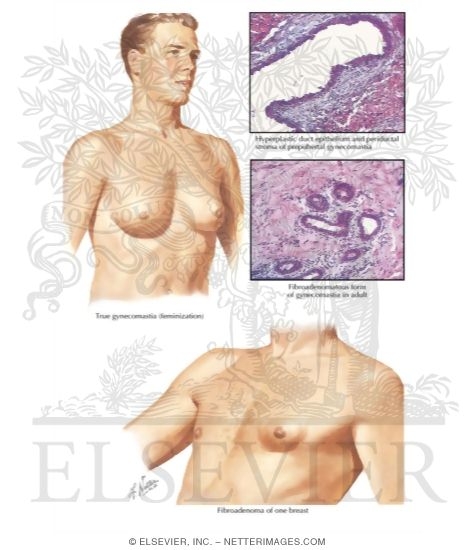 Watermarked preview of labeled image: Gynecomastia