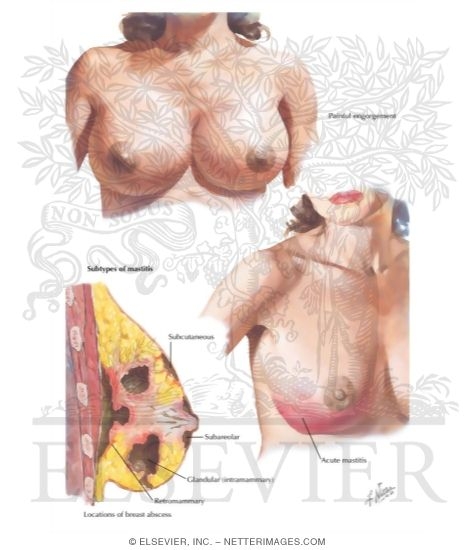 Watermarked preview of labeled image: Painful Engorgement, Puerperal Mastitis