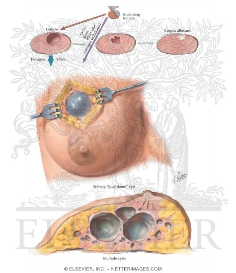 Chronic Cystic Mastitis III - Cystic Disease