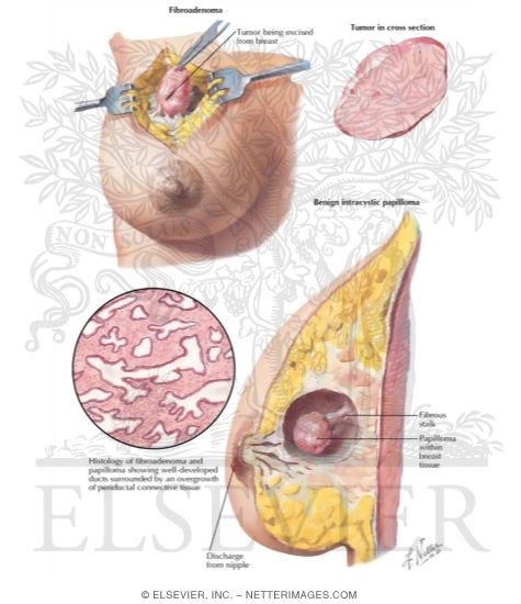 Watermarked preview of labeled image: Benign Fibro-adenoma, Intracystic Papilloma