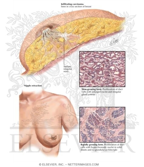 Watermarked preview of labeled image: Infiltrating Carcinoma (Scirrhus)