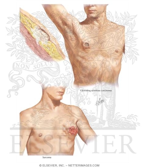 Malignancies Of Male Breast