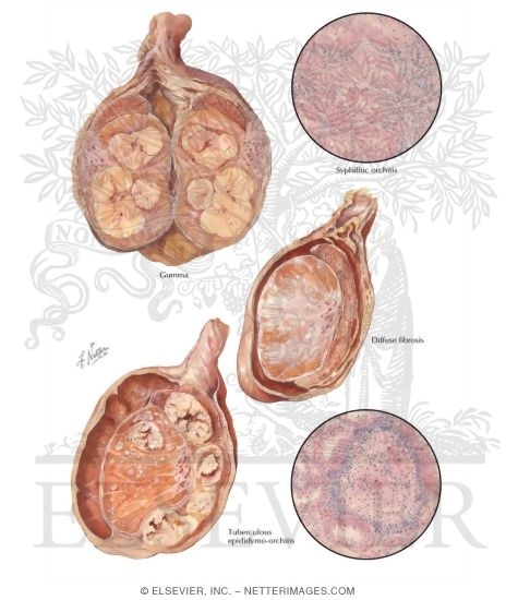 Netter Testis Granulomata of the Testicle
