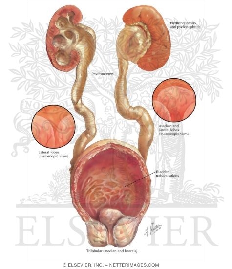 Watermarked preview of labeled image: Benign Prostatic Hypertrophy