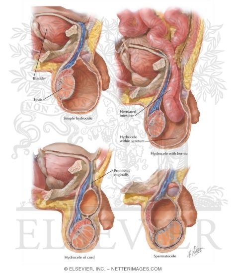 Hydrocele, Spermatocele