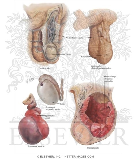 Varicocele, Hematocele, Torsion