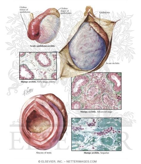 Infection and Abscess of the Testis and the Epididymis