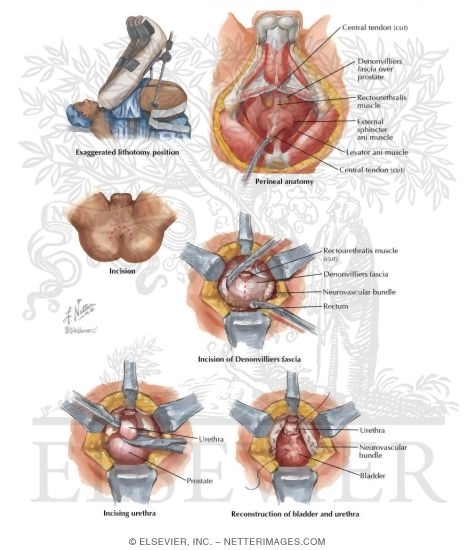 Malignant Prostate Surgery II: Perineal